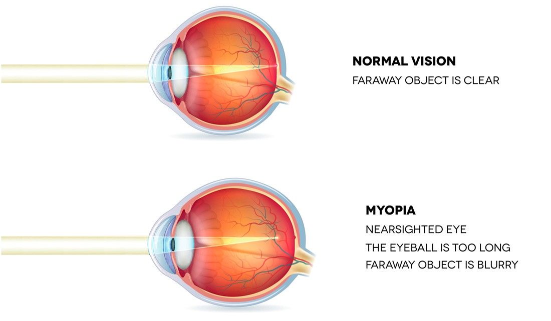 Myopia Doctor in Oradell